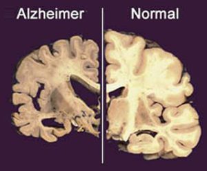 Sezione di cervello umano affetto da Alzheimer e sano - Alzheimer infezione batterica