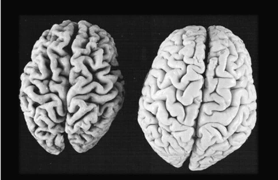 Anticorpo A13 La Nuova Molecola Che Blocca L Alzheimer