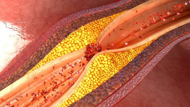 L'aterosclerosi è un accumulo di materiale lipidico imbrigliato in cellule muscolari liscie.
