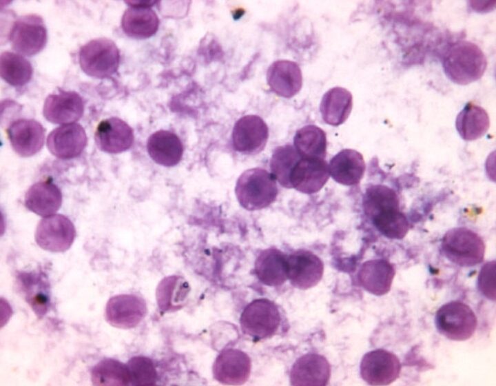 Figura 1 - Striscio di Pneumocystis jirovecii, precedentemente noto come Pneumocystis carinii, concentrato dal polmone umano - storia AIDS