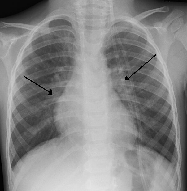 Radiografia del torace di un paziente affetto da bronchiolite da RSV 