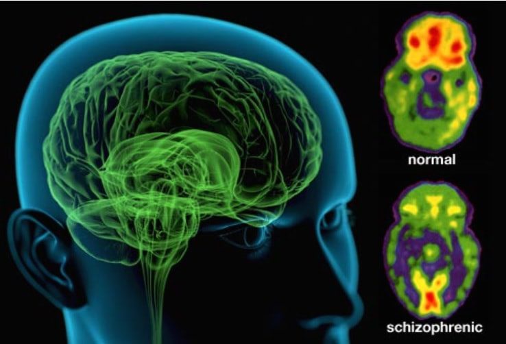 Differenze cerebrali tra pazienti normali e schizofrenici