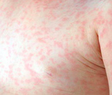 Esantema o rash cutaneo maculo-papulare costituito da macchie rosee e piatte, scatenato dall’attivazione della risposta immunitaria contro il virus.
