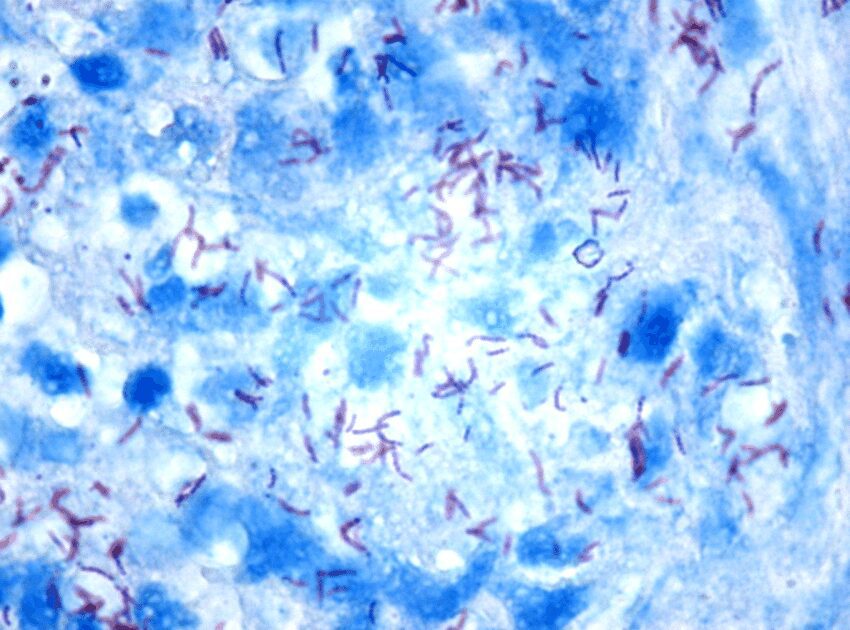 Microbacterium Tubercolosis al microscopio