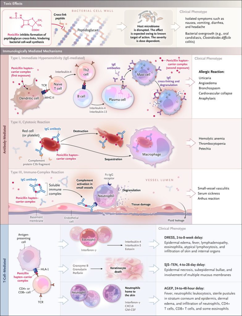 Figura 8 - Reazione allergica anafilattica scatenata da ipersensibilità alle penicilline; emagglutinazione e attivazione della risposta immunologica IgE mediata.