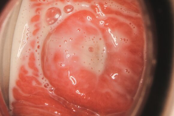 Immagine endoscopica dell'interno della vagina di un paziente che mostra vaginite (infiammazione vaginale) e leucorrea (secrezione biancastra) causata dalla trichomoniasi.