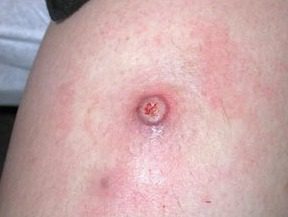 Lesione nodulare da Tanapox virus