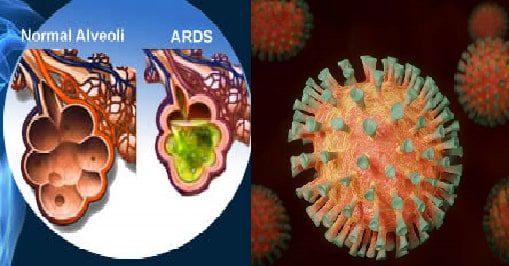 fisiopatologia di  ARDS associata a COVID-19