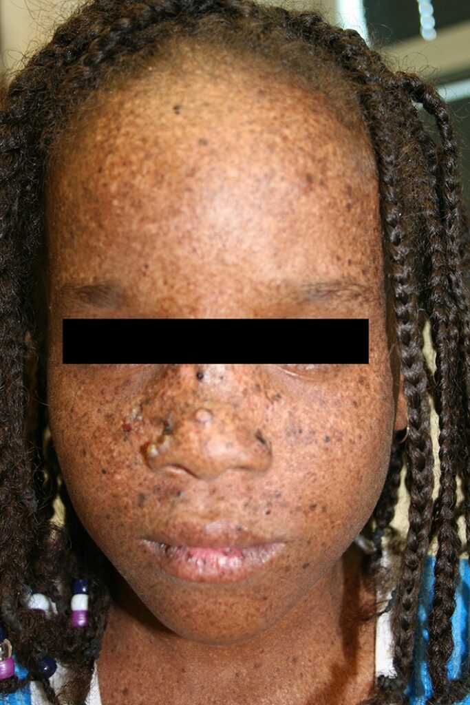 Ragazza affetta da Xeroderma Pigmentosum  - agenti mutageni