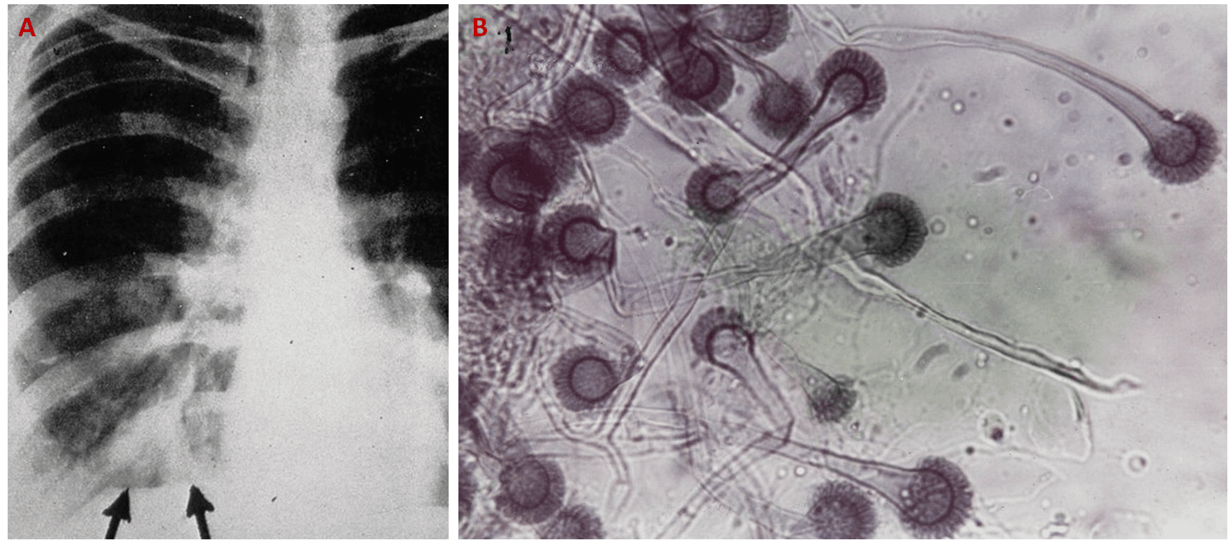 Figura 5 – A) Radiografia del torace in cui si vedono delle ombre (frecce) che appaiono come densità tubulari ramificate. Queste sono essudati intrabronchiali con ispessimento della parete dei bronchi; B) Conidi e conidiofori in un campione di lavaggio bronchiale
