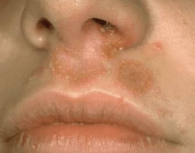 impetigine non bollosa