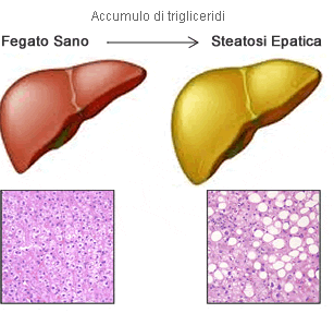 Struttura istologica di un fegato sano che mostra assenza di depositi di grassi sotto forma di goccioline lipidiche, confrontata con una struttura istologica di un fegato con steatosi epatica - alimentazione