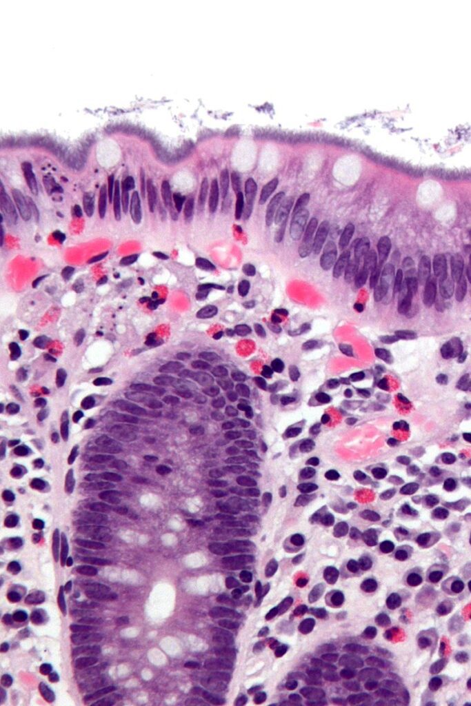 Spirochetosi intestinale umana 