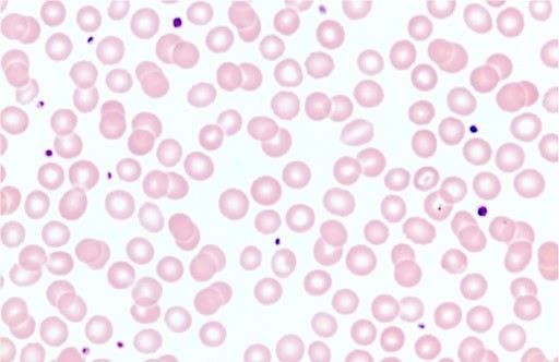 Striscio di sangue. Gli eritrociti sono colorati in rosa, mentre i frammenti di cellule più scuri sono piastrine
