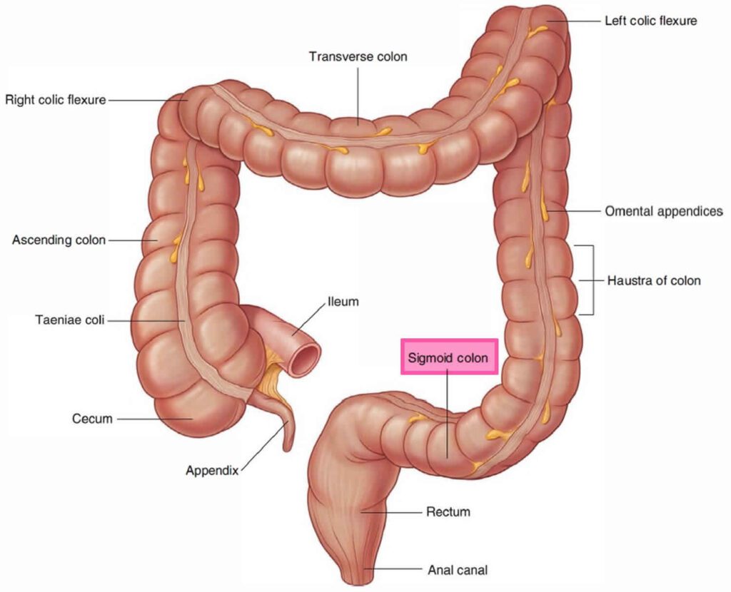 colon sigmoideo 