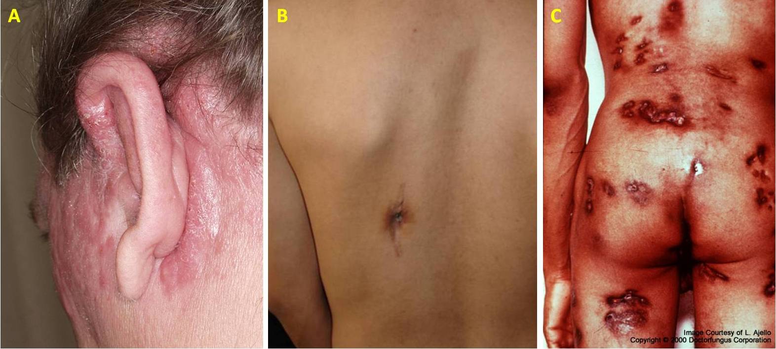 Figura 13 – Lesioni cutanee della coccidioidomicosi disseminata. A) Placche su orecchio, scalpo e guancia, B) Singola lesione ulcerativa sulla schiena e C) Lesioni multiple su schiena, gambe e glutei