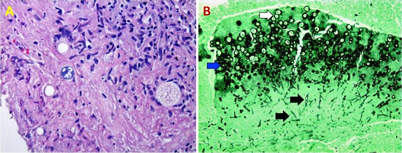 Figura 8 – Biopsia transbronchiale colorata con Ematossilina-Eosina (A) e biopsia pleurica colorata con metodo di Grocott-Gomori (B), che mostrano una lesione da Coccidioides nei polmoni. La freccia bianca indica le sferule, la freccia blu le endospore e le due frecce nere le ife