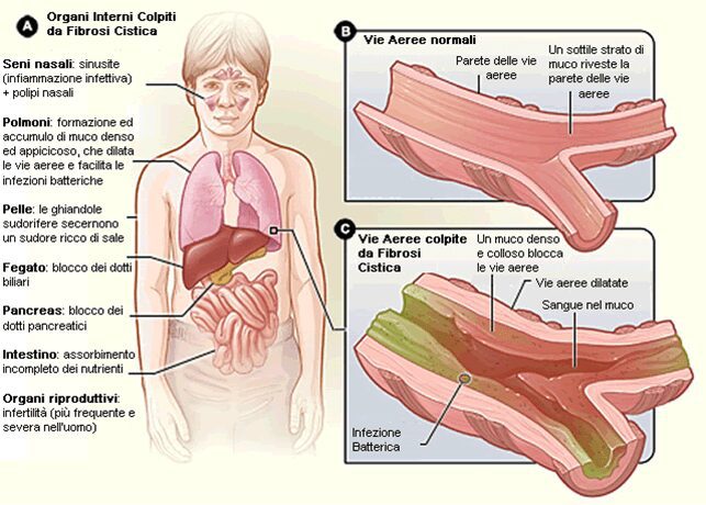 Figura 1 - Organi colpiti dalla fibrosi cistica