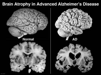 confronto tra cervello sano e affetto da Alzheimer