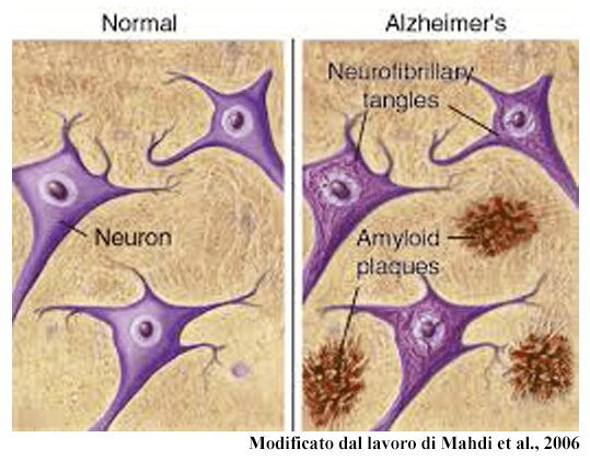 presenza di placche amiloidi nel tessuto cerebrale di soggetti affetti di Alzheimer