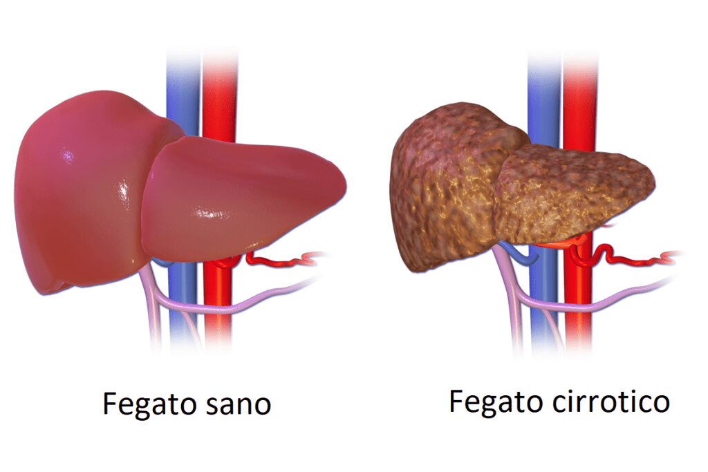 Rappresentazione di un fegato sano e di un fegato cirrotico posti a confronto. 