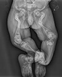 Aspetto radiologico di deformità ossea progressiva di un bambino affetto da Osteogenesi Imperfetta