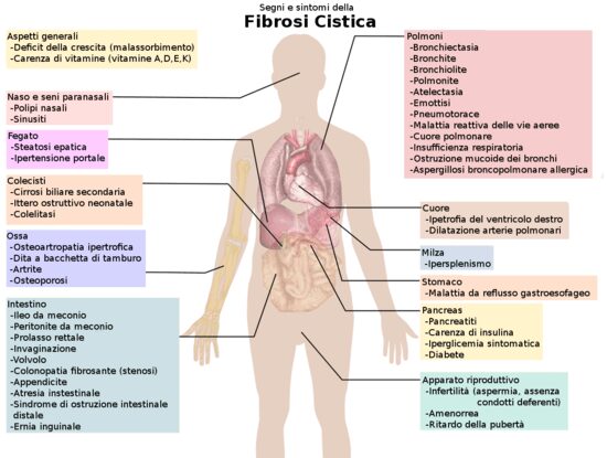 Segni e sintomi della Fibrosi cistica, malattia causata anche da Burkholderia 