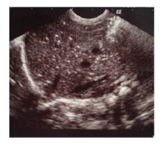 Ecografia dell'intestino di un neonato prematuro che mostra la presenza di gas intestinale in concomitanza di enterocolite necrotizzante. 