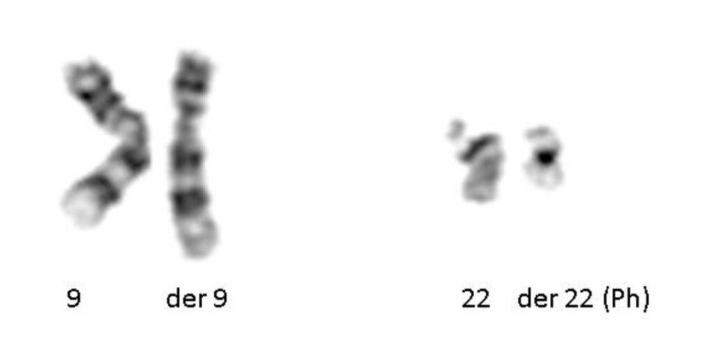 Traslocazione cromosomi 9 e 22