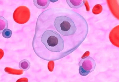 Le cellule multinucleate di Reed-Sternberg (HRS), tipiche del linfoma di Hodgkin