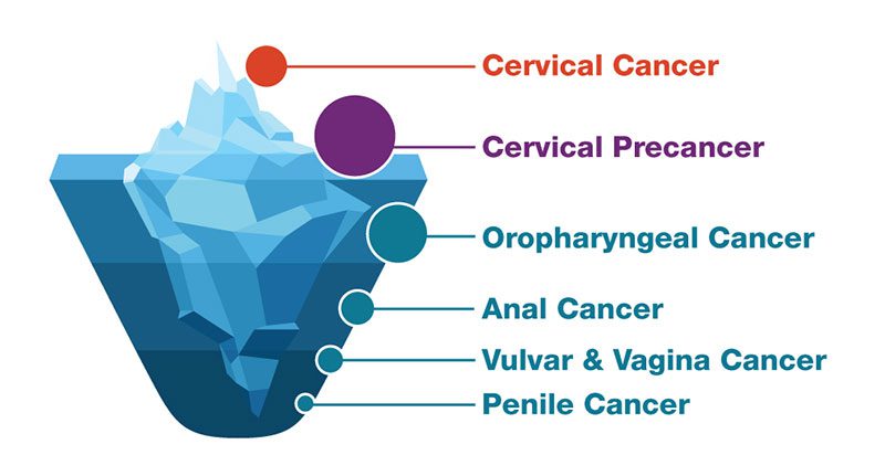 Il cancro alla cervice uterina è solo uno dei vari tipi di cancro che si possono contrarre con il papilloma virus