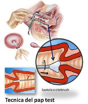 Tecnica di esecuzione del Pap test per la diagnosi del Papilloma virus