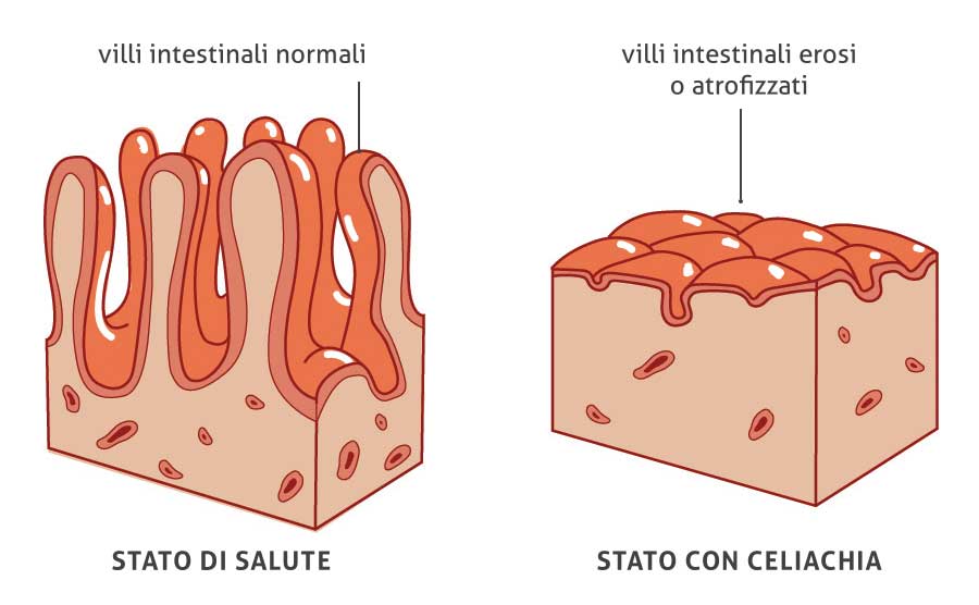 Figura 1: Rappresentazione dei villi intestinali durante lo stato di salute e quello della malattia.