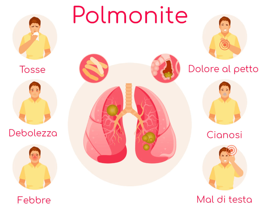 I sintomi più comuni della Polmonite