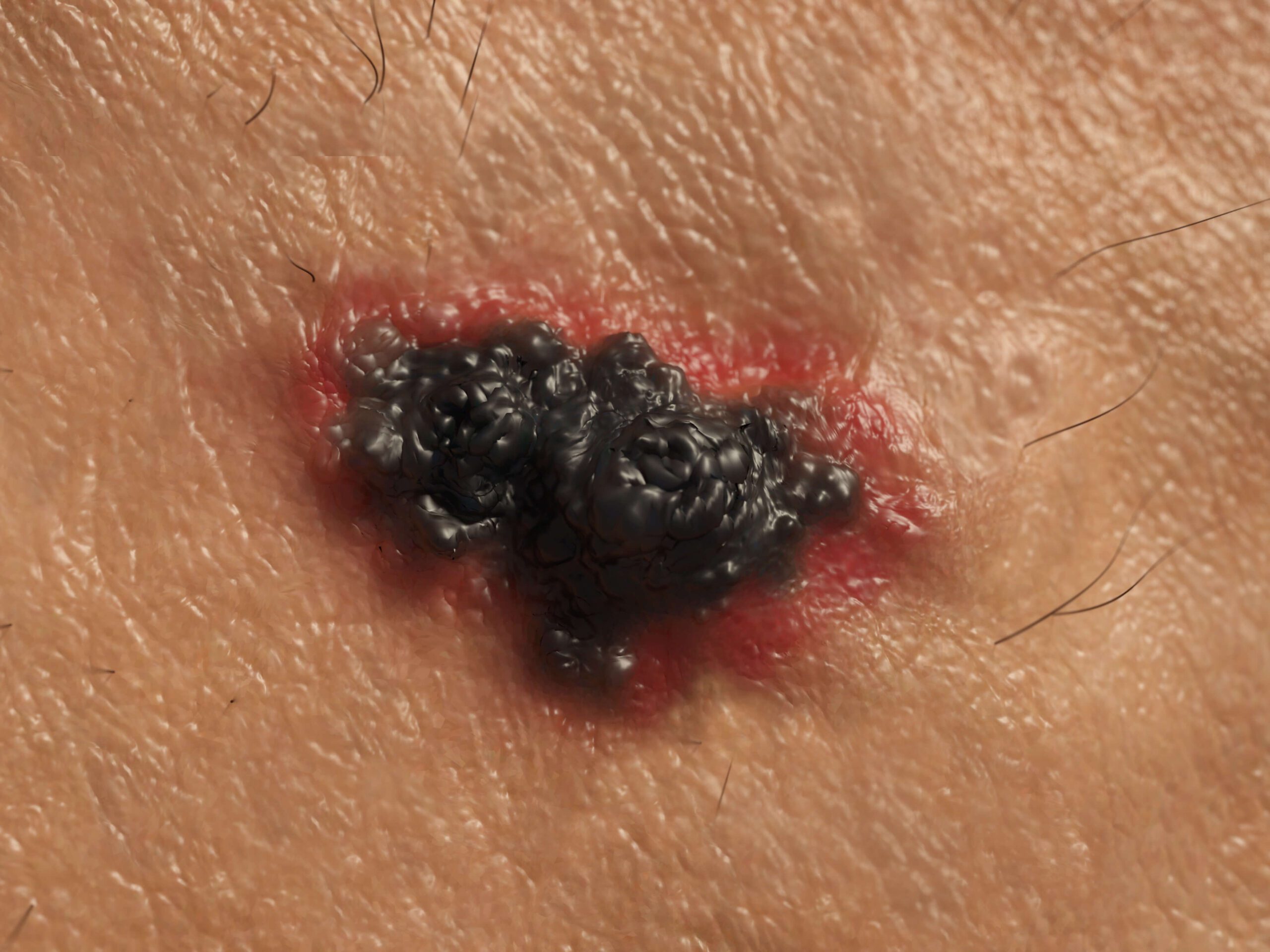 Riconoscere un Melanoma