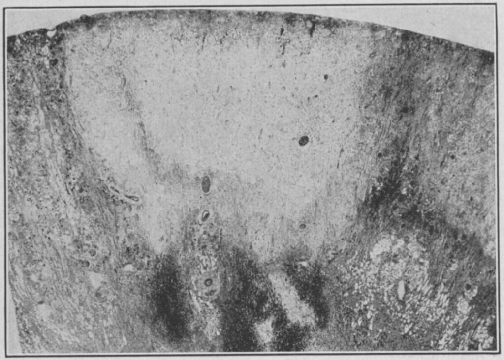 Figura 3 - Sezione di un rene con infarto corticale ed emorragia periferica, da paziente di 10 anni trattato con l'elisir per infezione alla gola, deceduto per avvelenamento dopo circa tre settimane