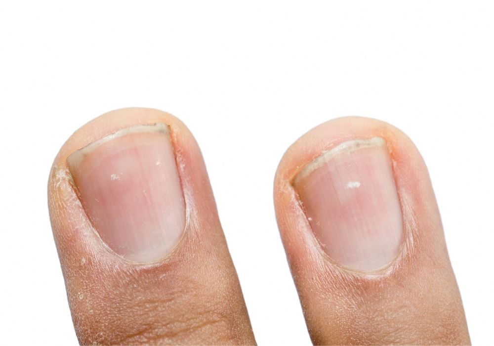 white-spots-on-nails-causes-symptoms-and-treatments-breaking-latest