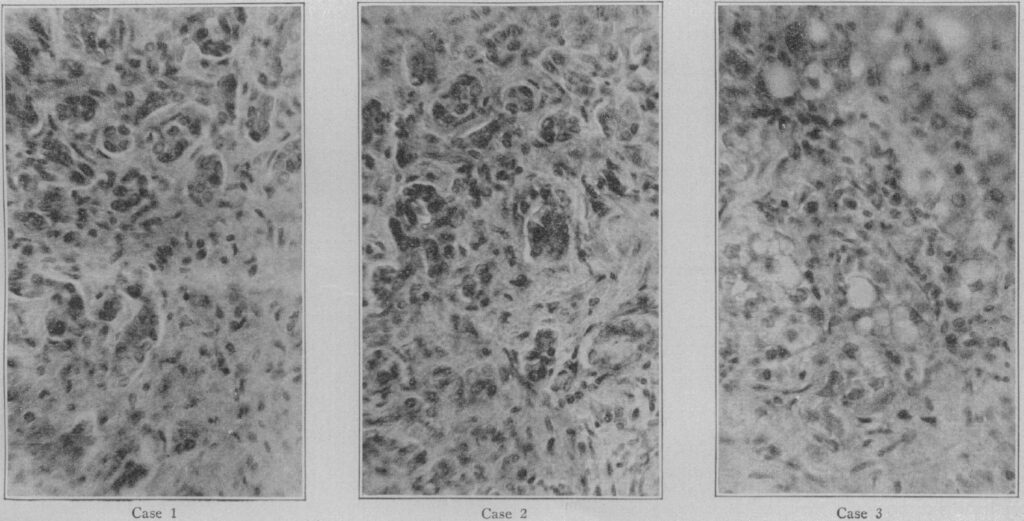 Figura 4 - Immagini al microscopio del tessuto del fegato di tre casi di morte riportati nel 1930