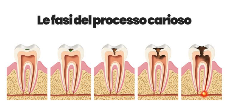 Carie Dentali: Prevenzione E Trattamento - Microbiologia Italia