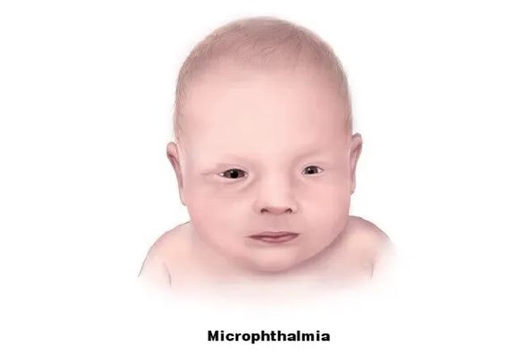 microftalmia congenita