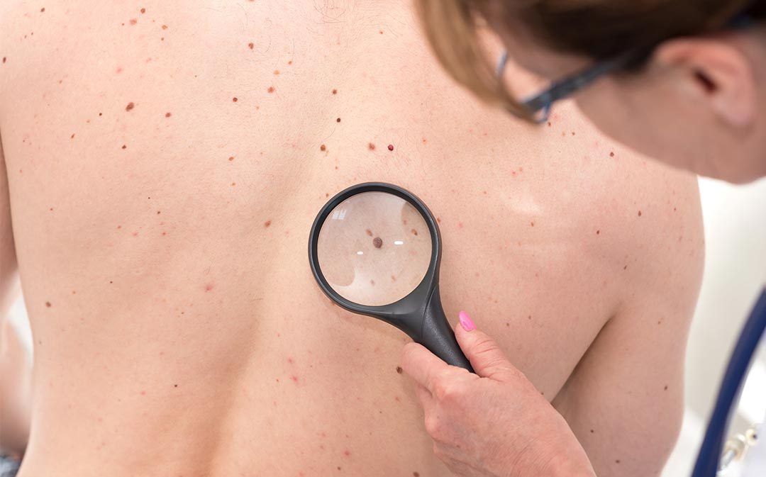 Nevi a rischio melanoma