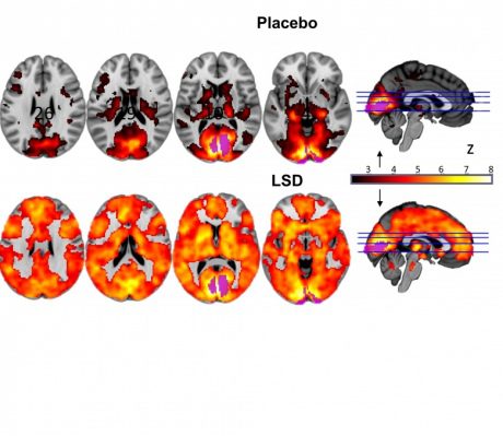 Neuroimaging in gruppo di controllo e gruppo sotto effetto di LSD
