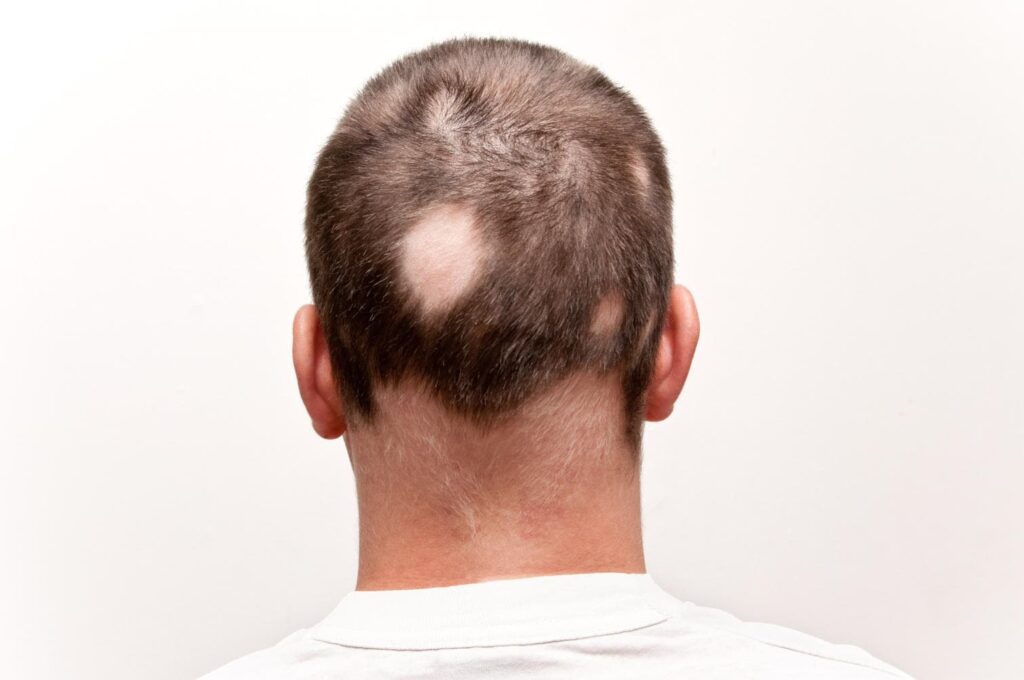 Alopecia perdita capelli