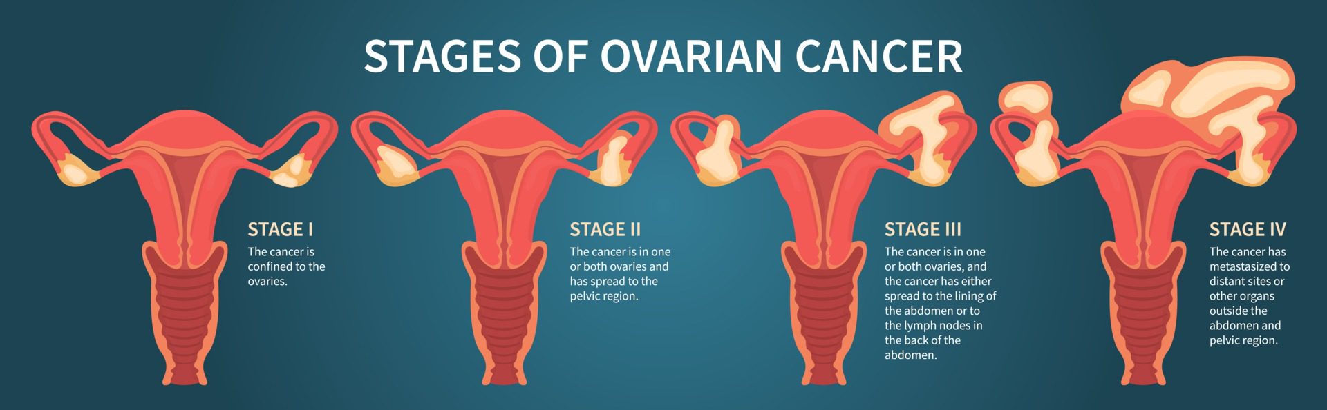 Cancro ovarico; fattori di rischio, fattori preventivi e i trattamenti ...