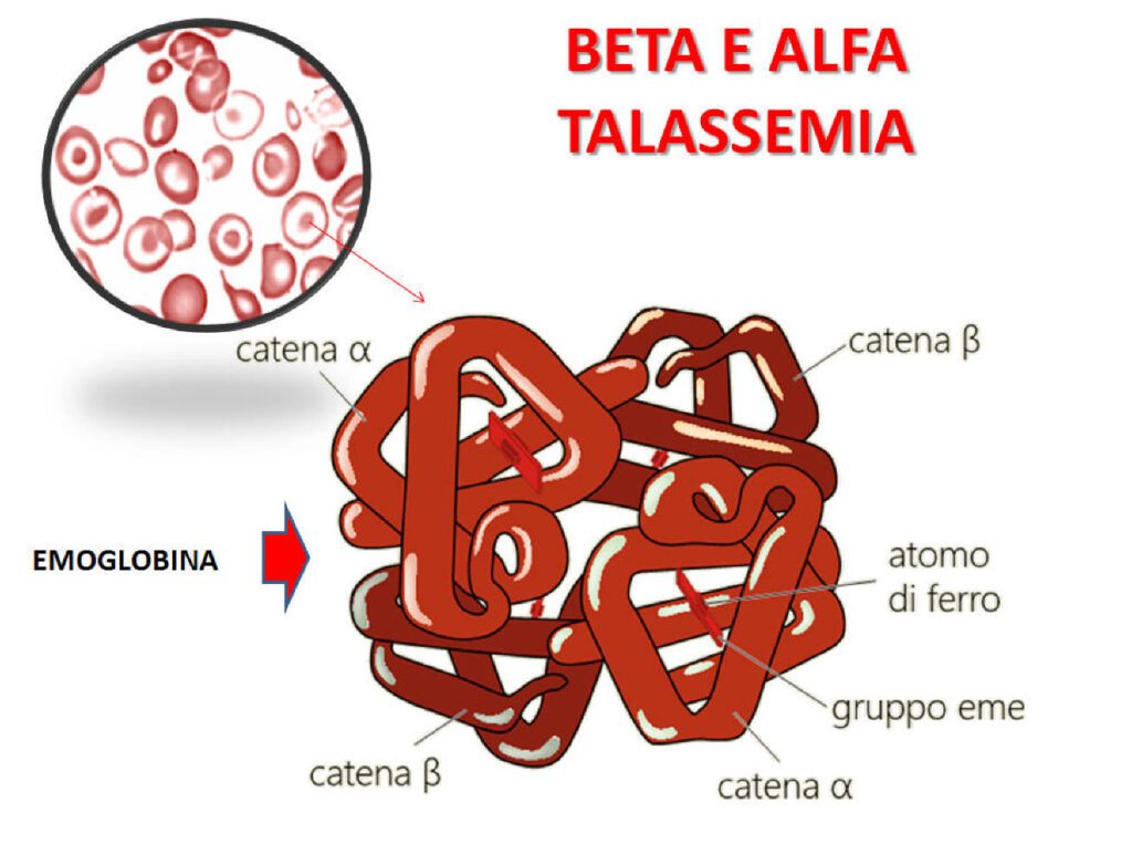 Diverse forme di Talassemia