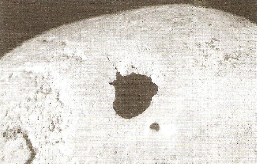 Cranio da Gravina di Puglia (BA) con foro da trapanazione e secondo foro provocato da un'arma appuntita