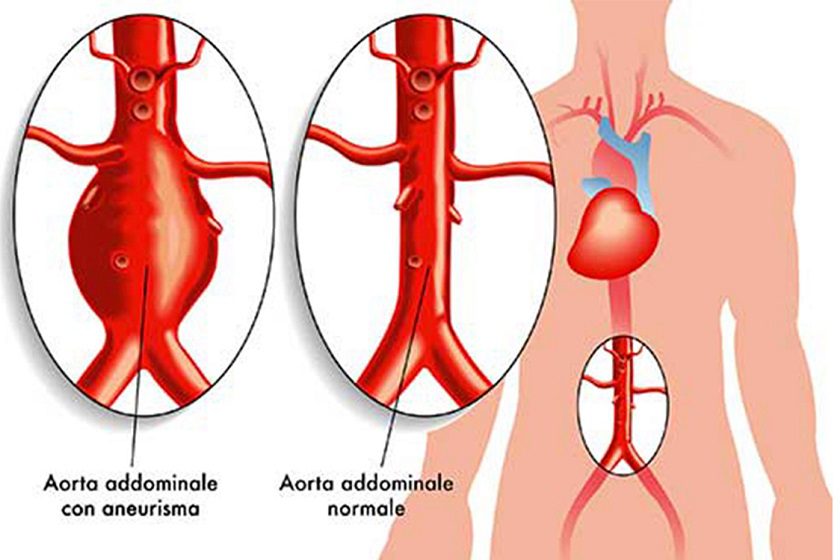 Aneurisma nell'aorta