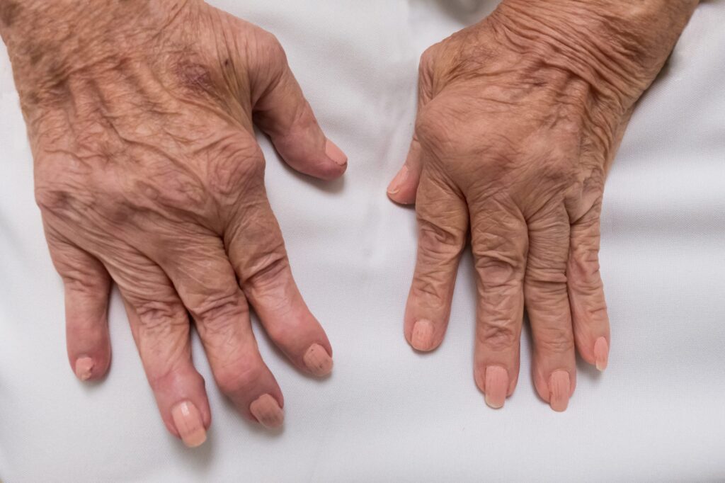 I reumatismi negli anziani
