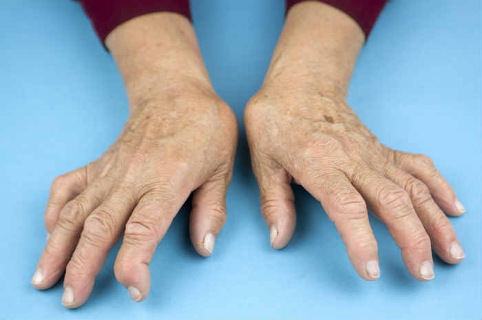 artrite segni