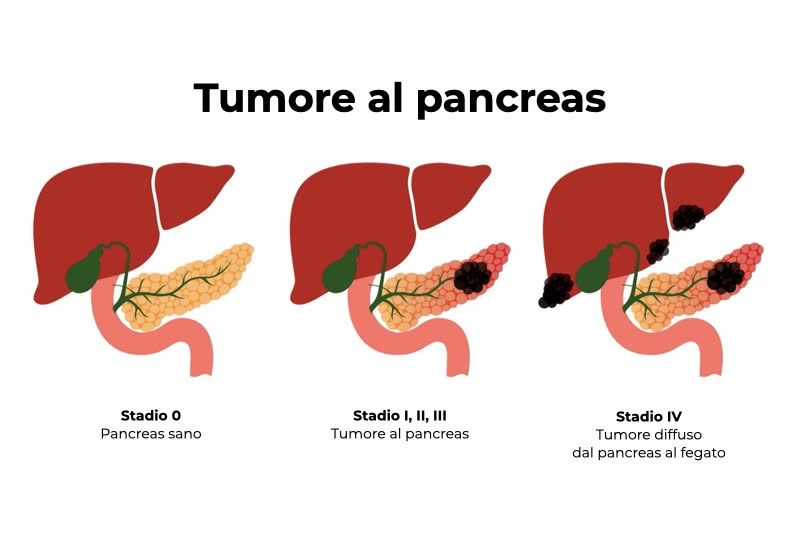 Tumore Pancreas